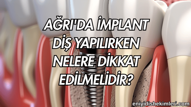 Ağrı'da İmplant Diş Yapılırken Nelere Dikkat Edilmelidir?