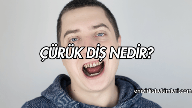 Çürük diş nedir?