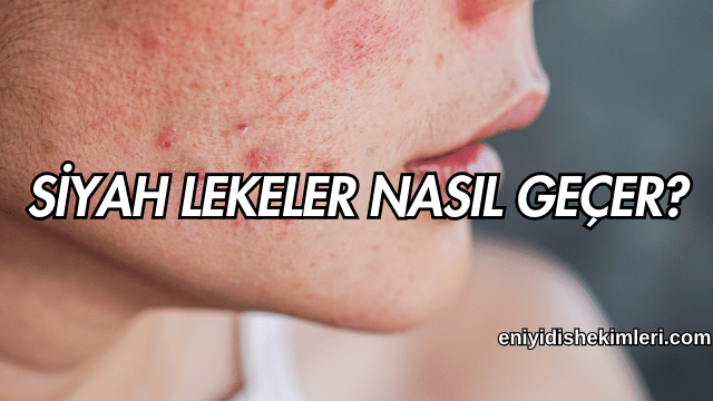 Siyah Lekeler Nasıl Geçer?