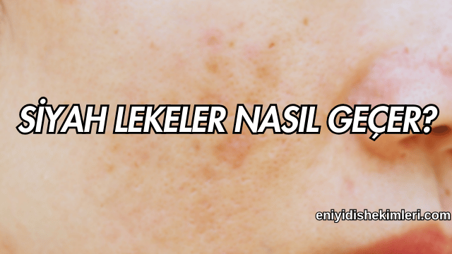 Siyah Lekeler Nasıl Geçer?