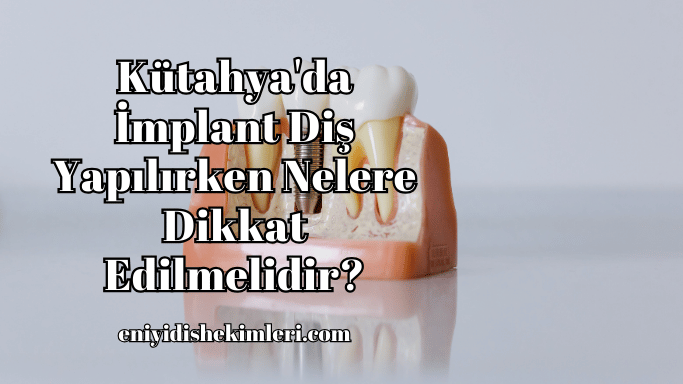 Kütahya'da İmplant Diş Yapılırken Nelere Dikkat Edilmelidir?