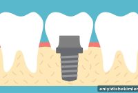 Dental Implants: Procedure, Risks, Recovery Timeline & FAQs