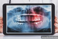 Wisdom Teeth: Photos, Symptoms, Surgery Guide & Pain Relief Tips