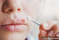 Cold Sore Treatment Guide: Home Remedies, Medications & Prevention