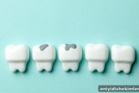 Amalgam Fillings Explained: Safety, Risks, and Removal Guide