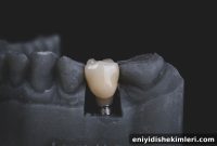 What to Expect Before a Dental Implant Procedure