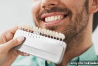 Are Veneers Worth It? Costs, Benefits, Risks, Procedure & FAQs
