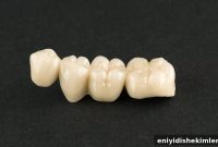Need a Dental Bridge? 4 Types, Costs, Uses & Alternatives