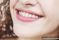 Ceramic Braces vs Metal Braces: Cost Comparison & FAQs