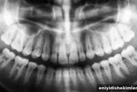Are Dental X-Rays Safe? Hidden Risks and What to Know