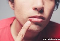 Cold Sore Pictures, Symptoms, Causes and Treatment Options