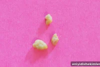 Tonsil Stones: Symptoms, Causes and Proven Removal Methods