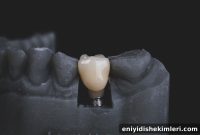 Dental Implant Process at MDIS Sun City Center: Step-by-Step Guide
