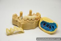 Affordable Dental Implants: Cost, Benefits, and What to Expect