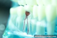 Root Canal Procedure: What to Expect During Treatment