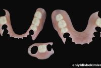 Relieve Pain and Soreness from a Valplast Denture Quickly