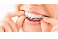 What I Wish I’d Known Before Getting Invisalign: Tips & Pitfalls