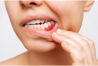 Bleeding Gums: What They Reveal About Your Overall Health