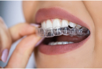 Mondays with Mark: Hidden Risks of Clear Aligners You Should Know