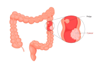 Mondays with Mark: Understanding Colorectal Cancer (CRC)