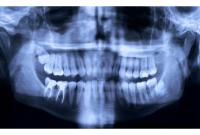 Are Dental X-Rays Safe? What Patients Need to Know