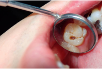 Childhood Cavities: Causes, Prevention, and Dental Care Tips