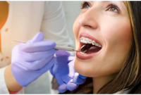 Invisalign with Permanent Retainers and Frenum Attachments: What to Expect
