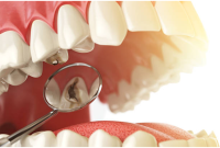 How I Reversed a Cavity: My Exact Step-by-Step Plan