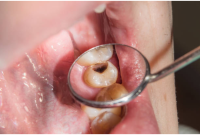 What I Did When My Granddaughter Got a Cavity: Step-by-Step Plan
