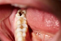 Can Cavities Be Reversed? What Science Says About Tooth Decay