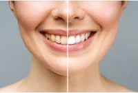 Teeth Stains vs Yellowing: Top Solutions That Really Work