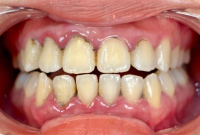 Receding Gums: What to Do Now — Treatment Options and Next Steps