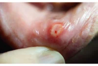 Why Do I Keep Getting Canker Sores? Causes, Triggers & Solutions