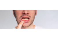 Why Men Are More Likely to Have Bleeding Gums Than Women