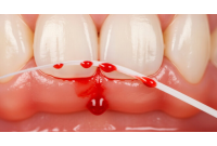 Bleeding Gums? Signs Your Dental Sealant Might Be Failing