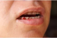 Bleeding Gums: What They Signal About Your Oral Health
