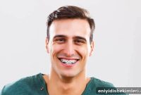 Why I Still Have a Gap Between My Teeth After 3 Years of Braces