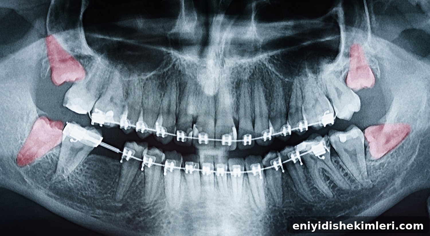 Wisdom Teeth: Photos, Symptoms, Surgery Guide & Pain Relief Tips 2 img 16455 1