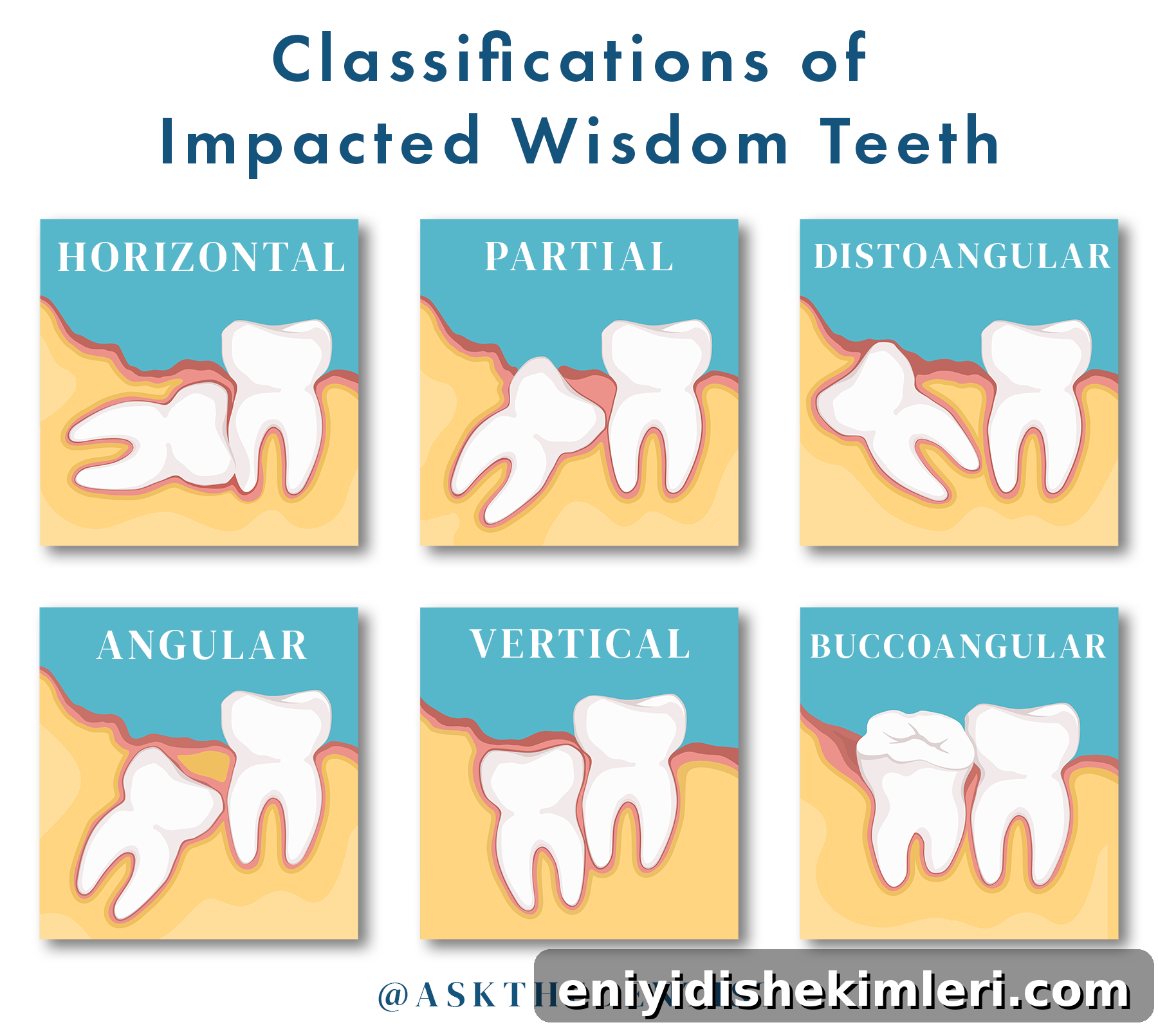 Wisdom Teeth: Photos, Symptoms, Surgery Guide & Pain Relief Tips 4 Classifications of Impacted Wisdom Teeth