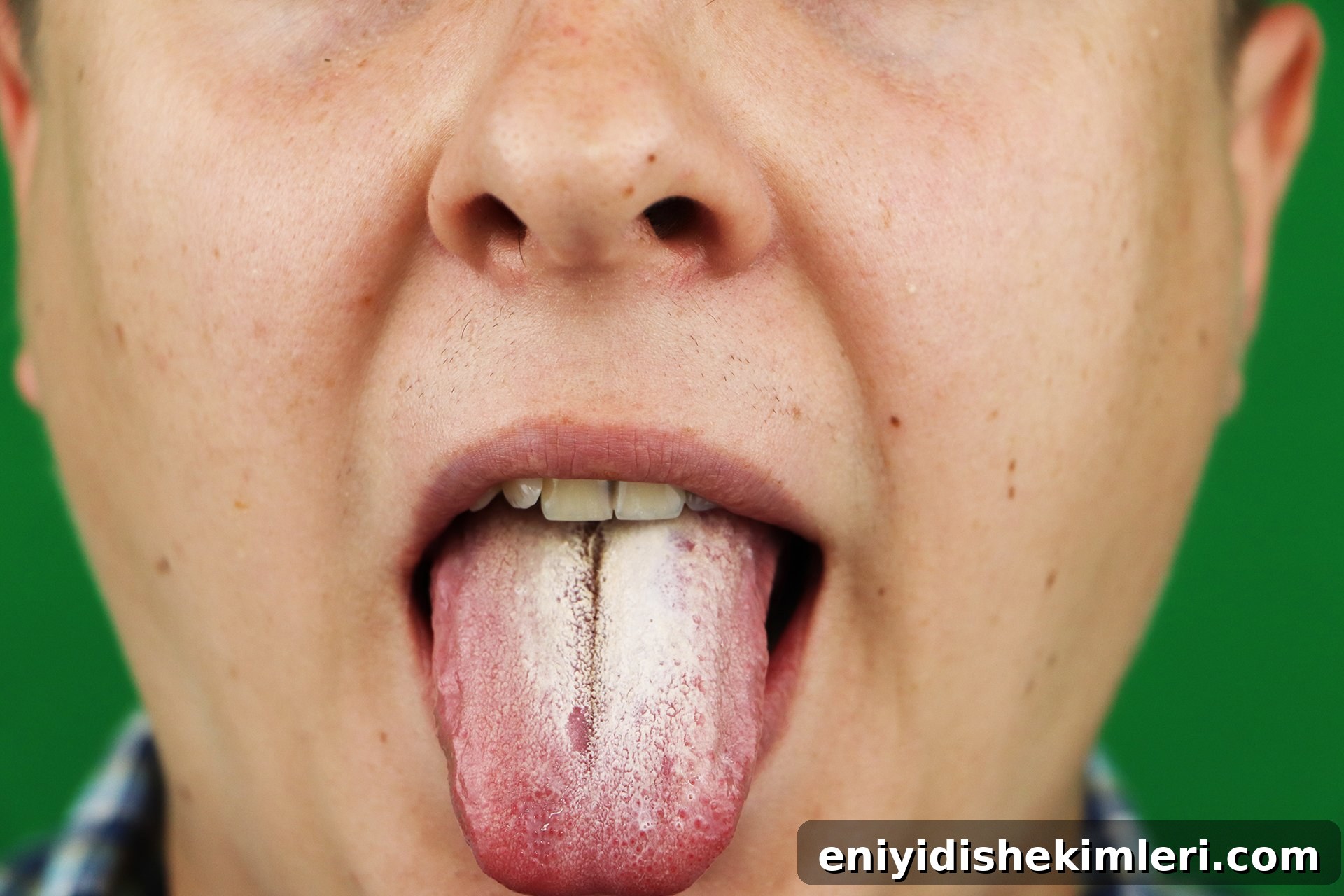Oral Thrush: Symptoms, Causes, and Home Treatments That Work 3 adult-man-oral-thrush-candidiasis-yeast-infection