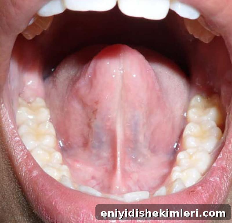 Tongue-Tie (Ankyloglossia): Symptoms, Diagnosis, Treatment & Recovery 2 Tongue Tie