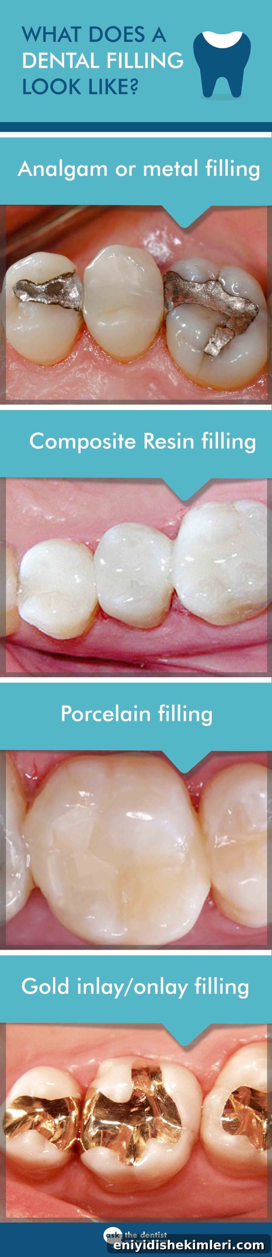 When You Need a Dental Filling: What to Expect at Your Visit 4 dental fillings
