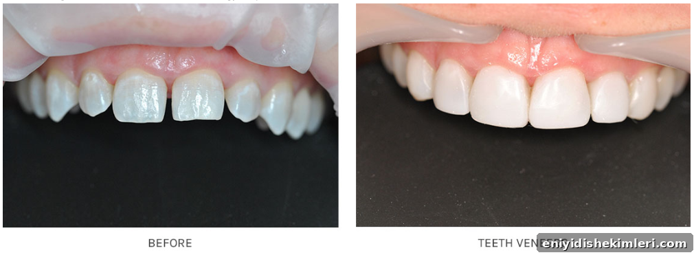 Are Veneers Worth It? Costs, Benefits, Risks, Procedure & FAQs 3 img 19877 2