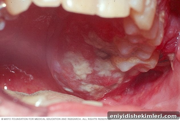 Oral Cancer Guide: Symptoms, Stages, Treatment Options & Prevention 3 img 19907 2