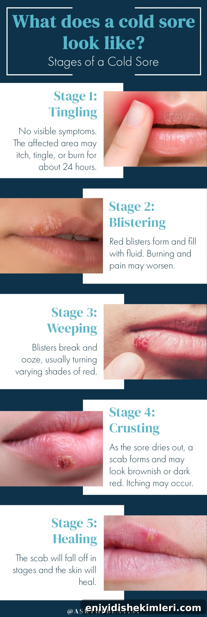 Cold Sore Pictures, Symptoms, Causes and Treatment Options 2 what-does-a-cold-sore-look-like, stages-of-a-cold-sore, cold-sore-stages, cold-sore-pictures
