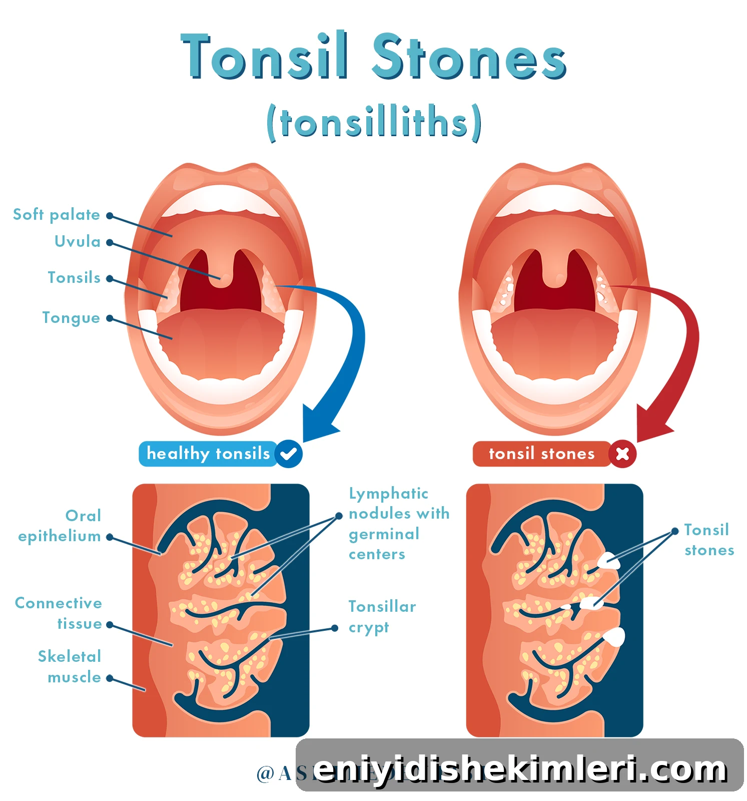 visual depiction of healthy tonsils and tonsil stones healthy tonsils and tonsil stones