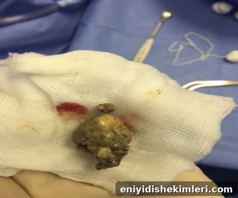 Tonsil Stones: Symptoms, Causes and Proven Removal Methods 2 img 22547 2