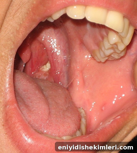 Tonsil Stones: Symptoms, Causes and Proven Removal Methods 3 img 22547 3