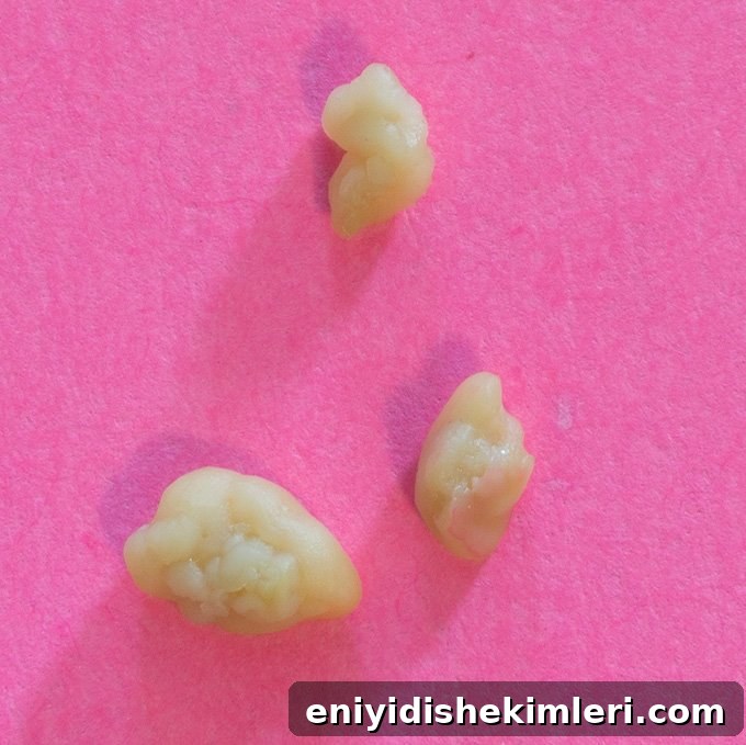Tonsil Stones: Symptoms, Causes and Proven Removal Methods 4 img 22547 4