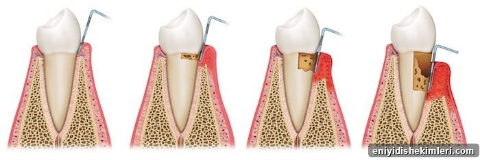 Does a Dental Cleaning Hurt? What to Expect at Your Visit 2 gum disease progression